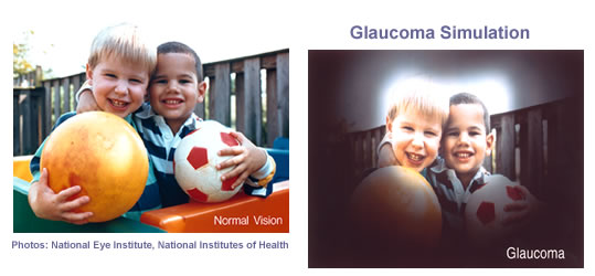 Glaucoma Simulation